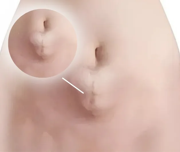 incisional hernia